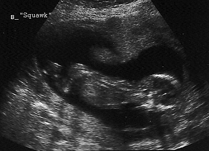 Squawk 14 weeks ultrasound