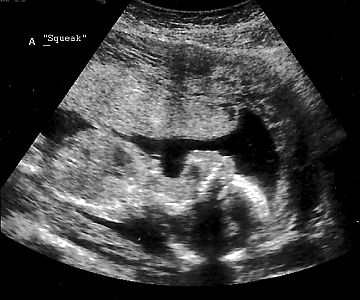 Squeak 18 week ultrasound