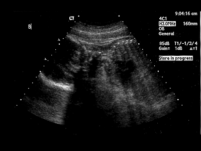 Squawk 32 week ultrasound