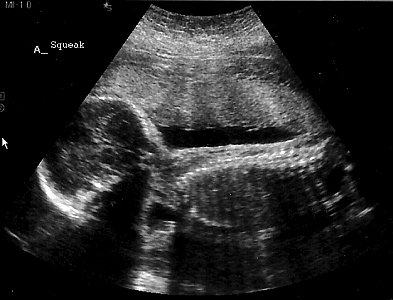 Squeak 24 week ultrasound