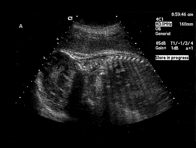 Squeak 32 week ultrasound